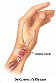 dequervain szindróma fájdalom a kezek csontainál és ízületeiben