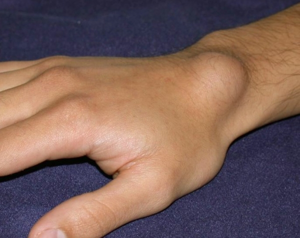 a kéz csuklóízületi tünetei és kezelése