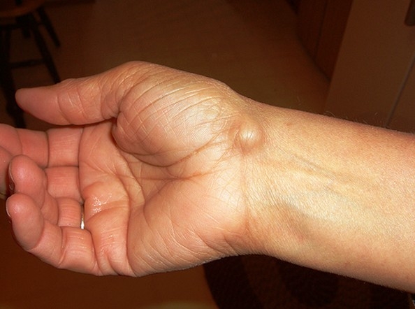izületi csomók kézen kezelési gyakorlat a boka artrózisában