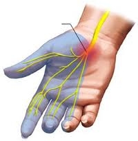 Kéztőalagút (carpal tunnel) szindróma