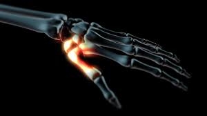 a kéz ízületeinek deformáló arthrosisa