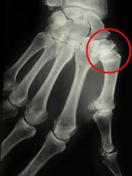 artrózis deformáló kezelés kezével
