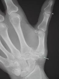 a kéz deformáló arthrosisa
